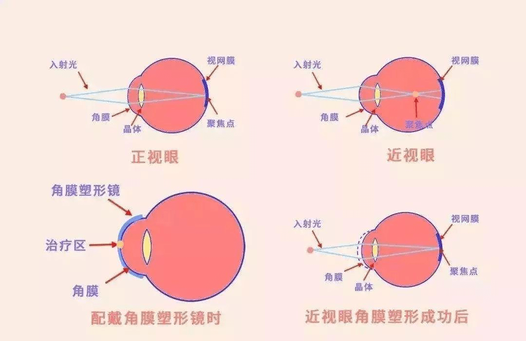 儿童眼轴最新研究与发展，理解、预防与干预