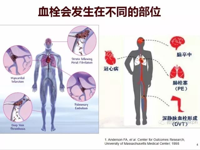 最新血栓治疗技术，重塑健康的未来